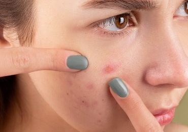 Acné adulto: cómo cuidar tu piel con tratamientos rápidos