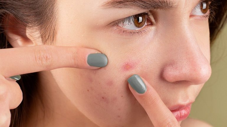 Acné adulto: cómo cuidar tu piel con tratamientos rápidos